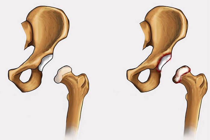 degeneratívne zmeny a bolesti v bedrovom kĺbe