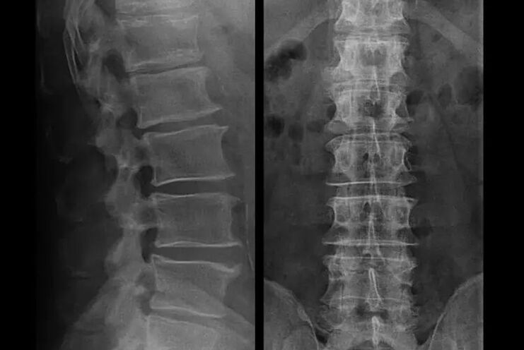 osteochondróza na röntgene