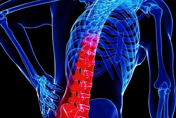 Dôvody rozvoja hrudnej osteochondrózy
