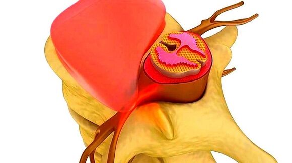 Osteochondróza hrudnej chrbtice podstata choroby